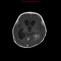 Atypical teratoid rhabdoid tumor (Radiopaedia 10712-11183 Axial T1 C+ 10).jpg