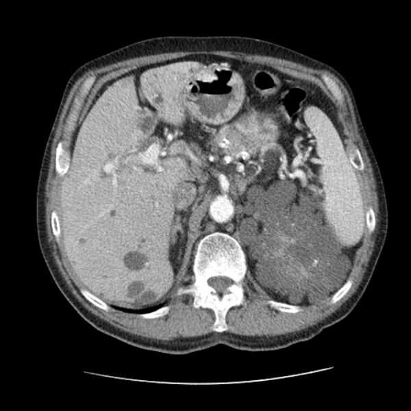 File:Autosomal dominant polycystic kidney disease (Radiopaedia 27851-28094 B 60).jpg
