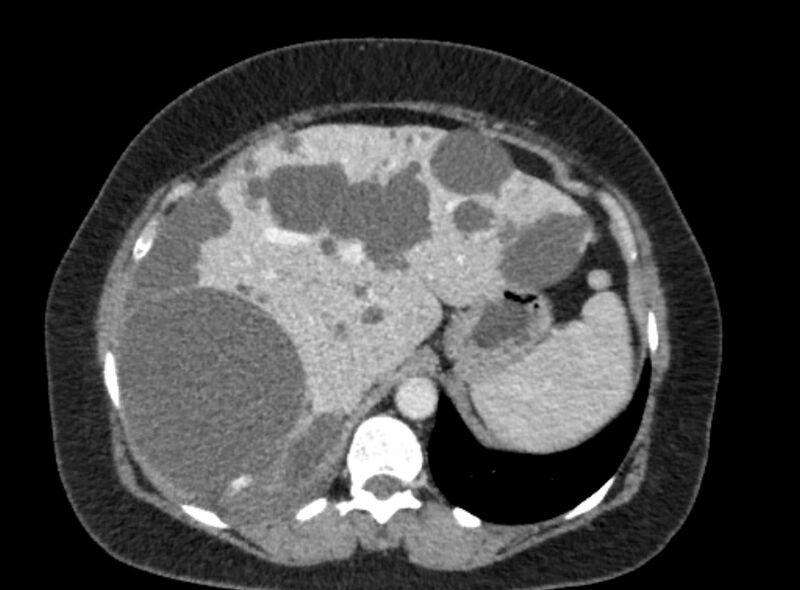File:Autosomal dominant polycystic kidney disease (Radiopaedia 57124-64017 A 31).jpg
