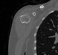 Avulsion fracture - greater tuberosity of humerus (Radiopaedia 71216-81514 Coronal bone window 10).jpg