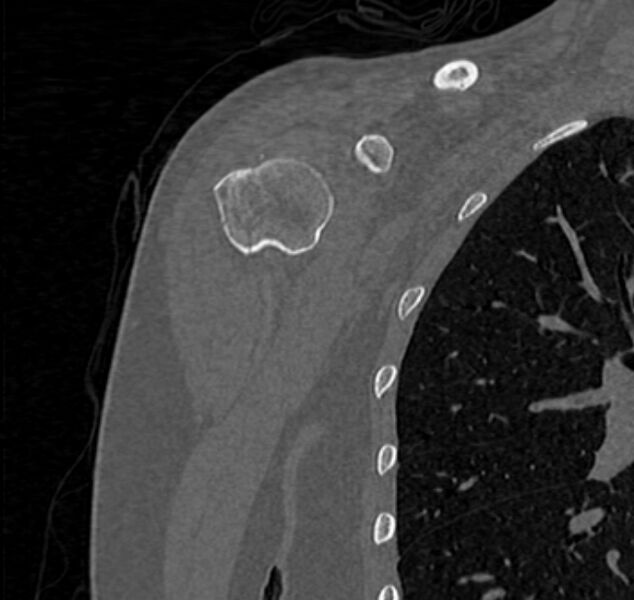 File:Avulsion fracture - greater tuberosity of humerus (Radiopaedia 71216-81514 Coronal bone window 10).jpg