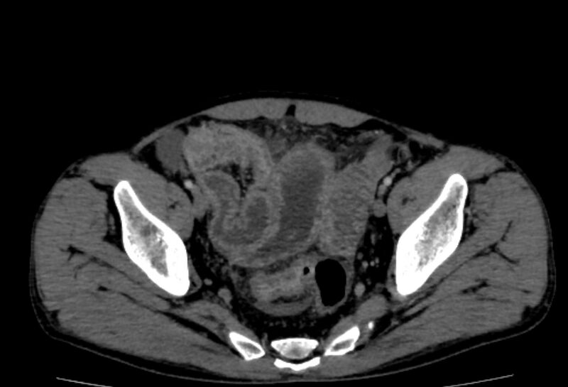 File:Behçet's disease- abdominal vasculitis (Radiopaedia 55955-62570 A 78).jpg