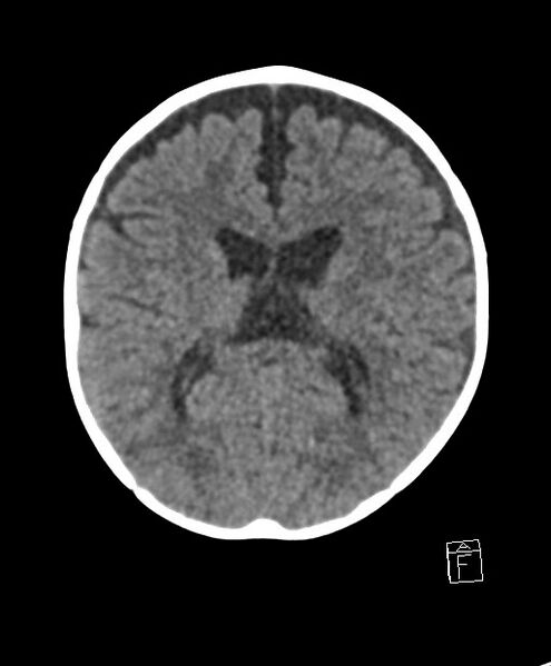 File:Benign enlargement of subarachnoid spaces in infancy (BESS) (Radiopaedia 87459-103795 Axial non-contrast 39).jpg