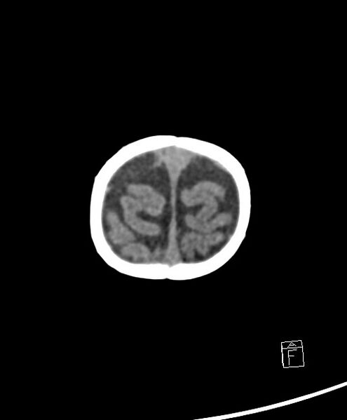 File:Benign enlargement of subarachnoid spaces in infancy (BESS) (Radiopaedia 87459-103795 Axial non-contrast 6).jpg