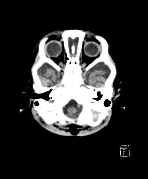 File:Benign enlargement of subarachnoid spaces in infancy (BESS) (Radiopaedia 87459-103795 Axial non-contrast 75).jpg