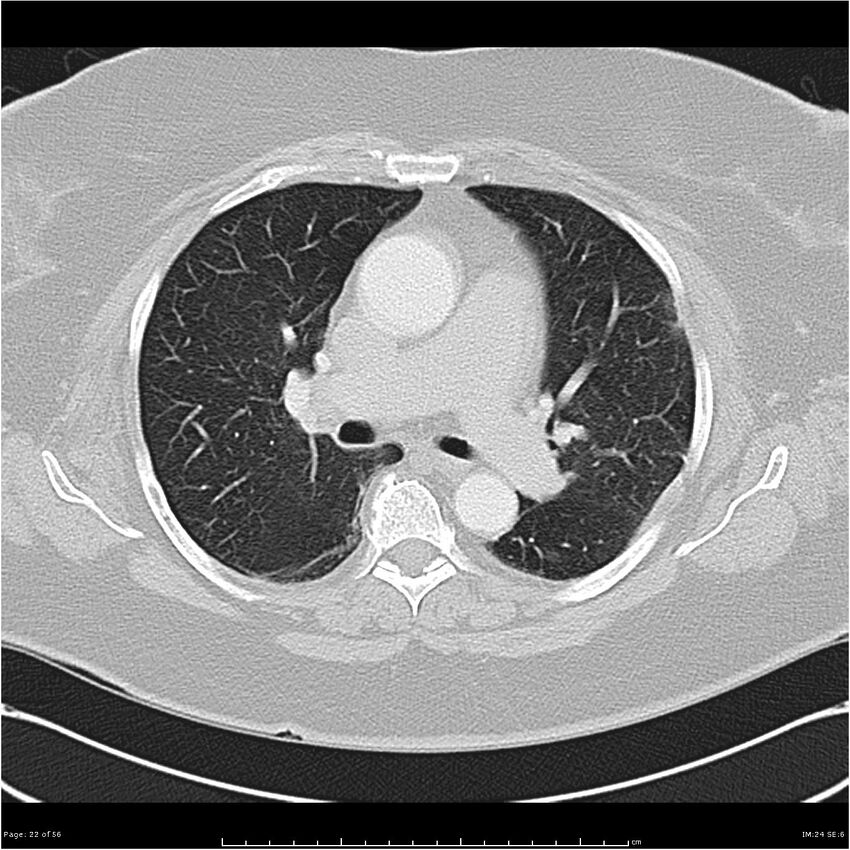 Benign metastasizing leiomyoma (Radiopaedia 26803-26962 Axial lung window 22).jpg