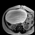 Benign seromucinous cystadenoma of the ovary (Radiopaedia 71065-81300 B 27).jpg