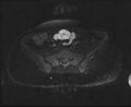 Bicornuate bicollis uterus (Radiopaedia 61626-69616 Axial PD fat sat 6).jpg