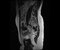 Bicornuate bicollis uterus (Radiopaedia 61626-69616 Sagittal T2 11).jpg