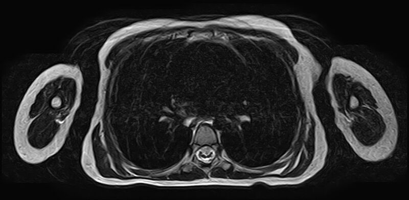 File:Bilateral Sprengel deformity with Klippel-Feil syndrome (Radiopaedia 66395-75650 Axial T2 32).jpg