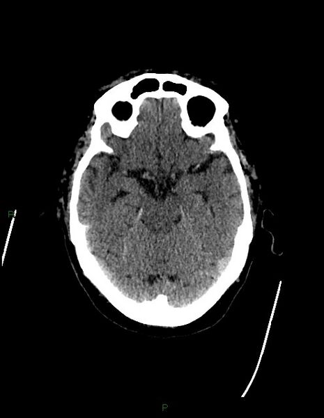 File:Bilateral acute middle cerebral artery territory infarcts (Radiopaedia 77319-89401 Axial non-contrast 31).jpg