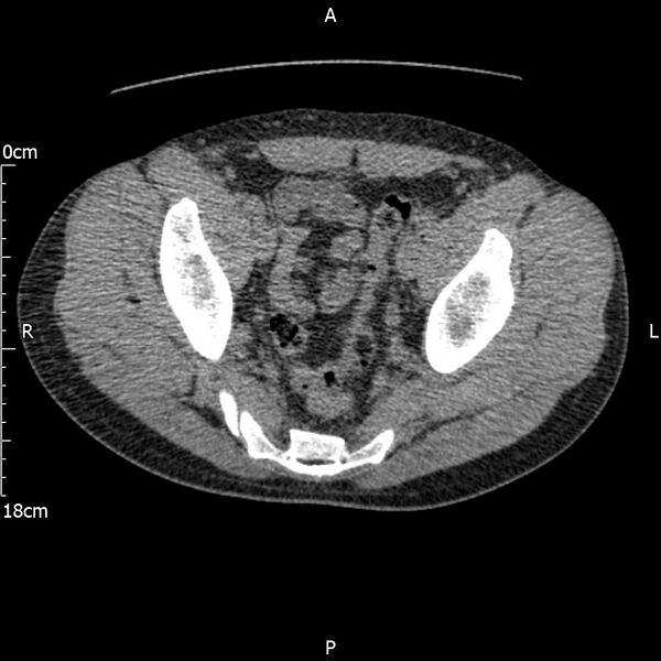 File:Bilateral medullary nephrocalcinosis with ureteric calculi (Radiopaedia 71269-81569 Axial non-contrast 113).jpg