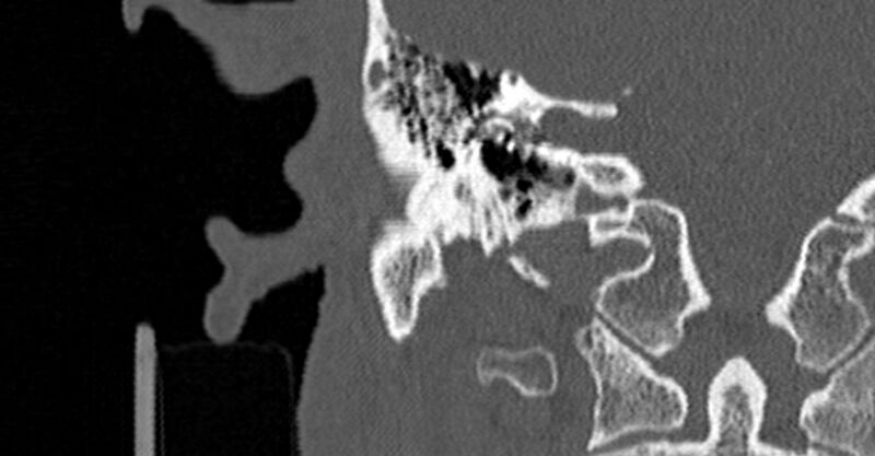 File:Bilateral temporal bone fractures (Radiopaedia 29482-29970 Coronal non-contrast 116).jpg