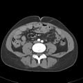 Biliary necrosis - liver transplant (Radiopaedia 21876-21845 A 42).jpg