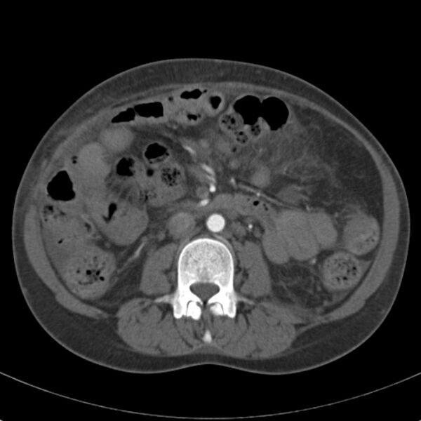 File:Biliary necrosis - liver transplant (Radiopaedia 21876-21846 A 38).jpg
