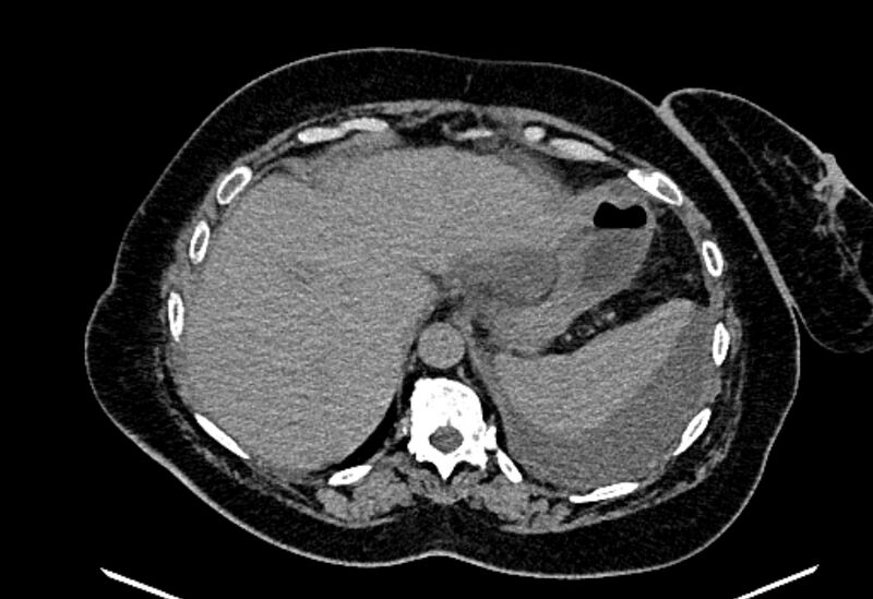 File:Biliary pancreatitis (Radiopaedia 72289-82823 Axial non-contrast 61).jpg