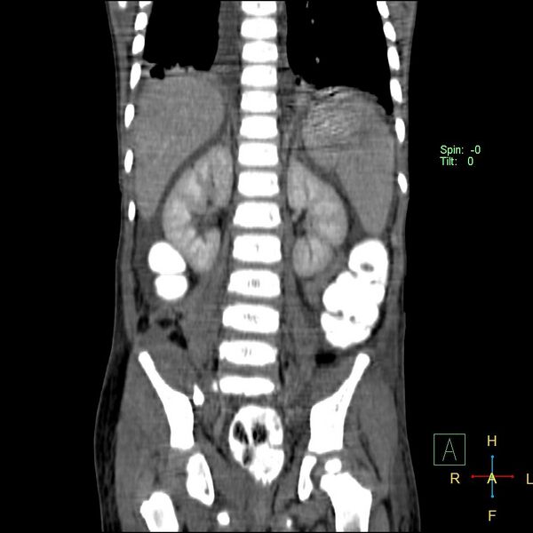 File:Blunt abdominal trauma (Radiopaedia 24780-25044 C 15).jpg