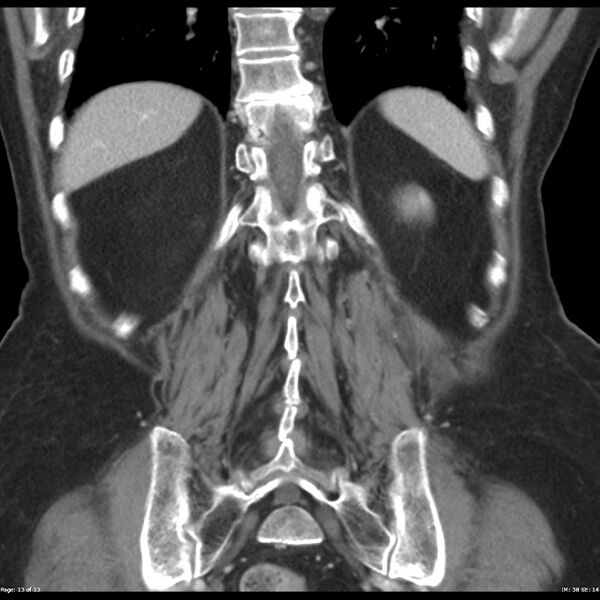 File:Bosniak renal cyst - type IIF (Radiopaedia 23385-23450 B 13).jpg
