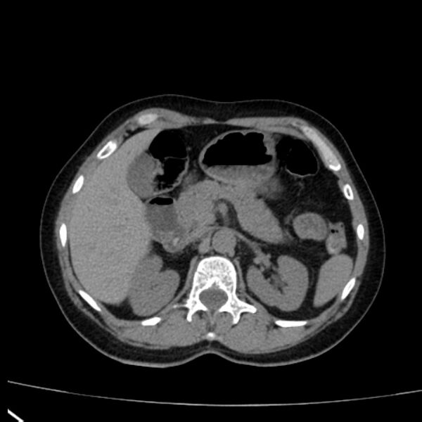 File:Bosniak renal cyst - type I (Radiopaedia 27479-27675 Axial non-contrast 28).jpg
