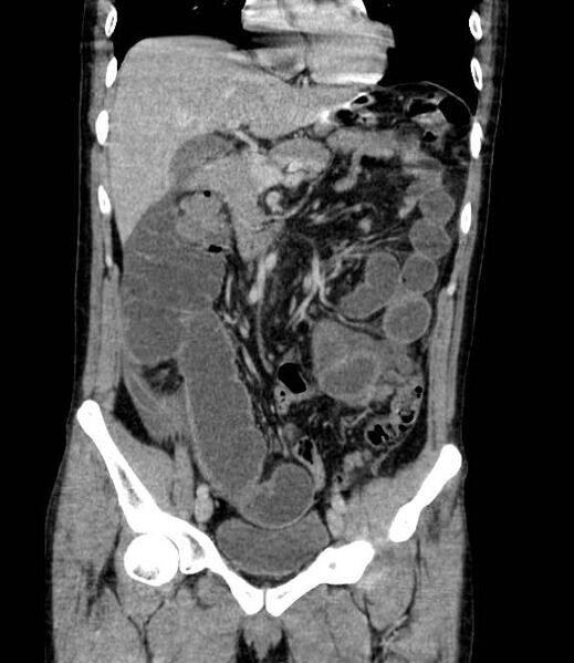 File:Bowel obstruction from colon carcinoma (Radiopaedia 22995-23028 C 31).jpg