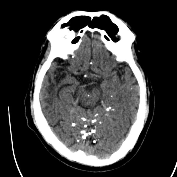 File:Brain Pantopaque remnants (Radiopaedia 78403-91048 Axial non-contrast 41).jpg