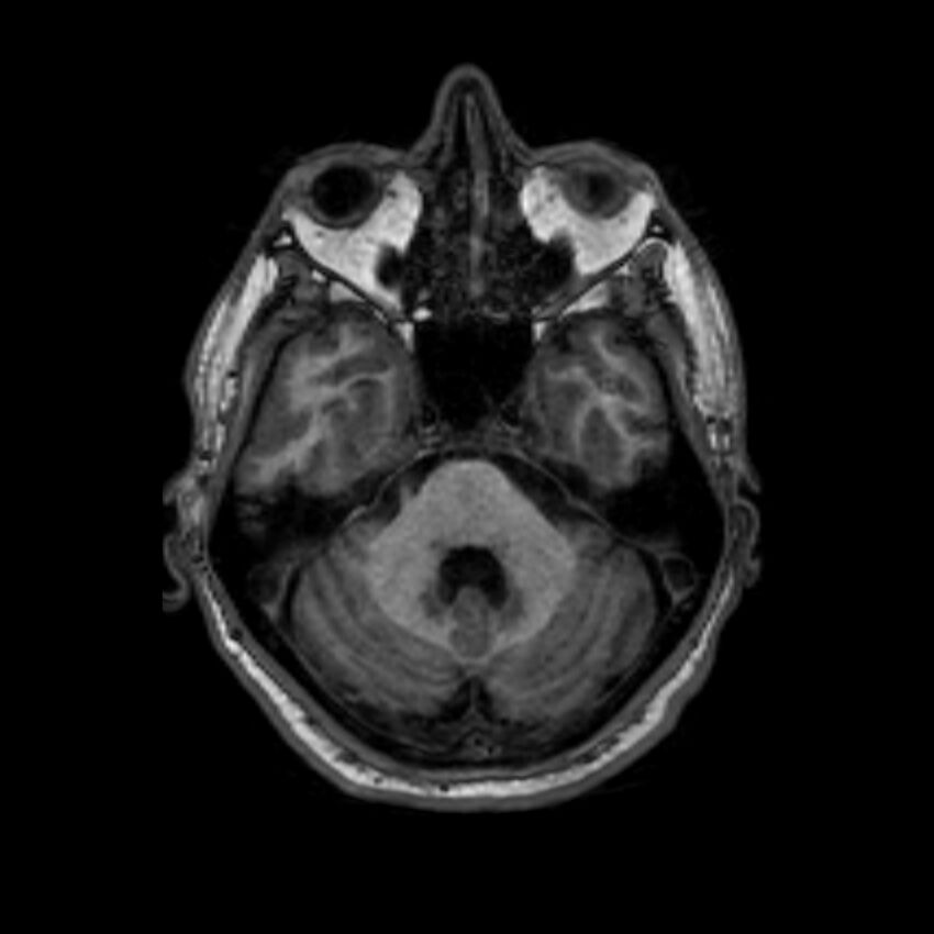 Brain abscess complicated by intraventricular rupture and ventriculitis (Radiopaedia 82434-96577 Axial T1 15).jpg