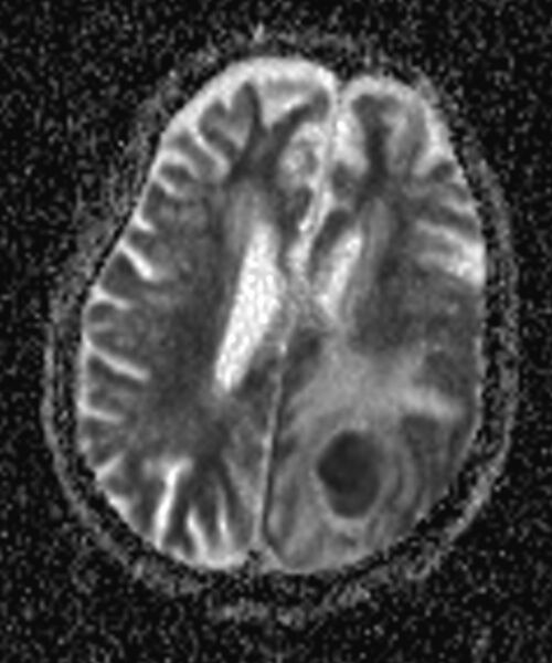 File:Brain abscess with dual rim sign (Radiopaedia 87566-103938 Axial ADC 13).jpg