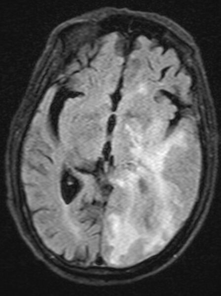 File:Brain abscess with dual rim sign (Radiopaedia 87566-103938 Axial FLAIR 11).jpg