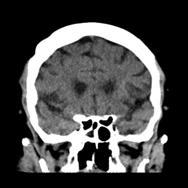 File:Brain cortical laminar necrosis (Radiopaedia 25822-25971 C 19).jpg