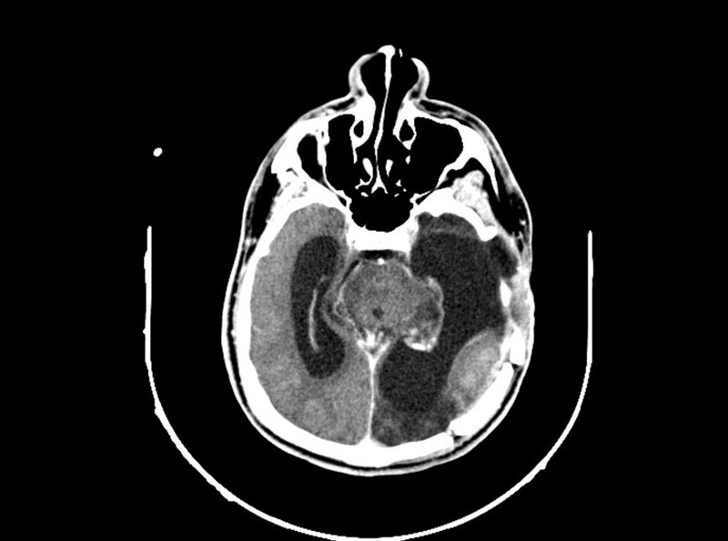 File:Brain injury by firearm projectile (Radiopaedia 82068-96088 B 111).jpg