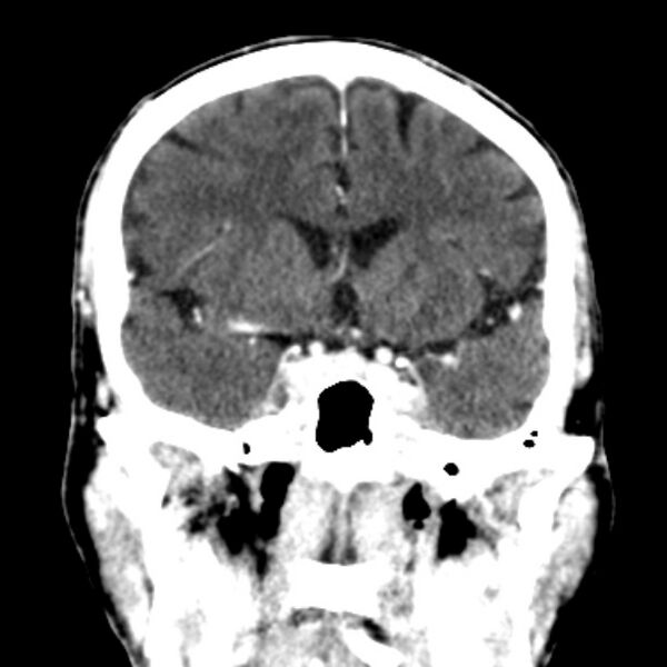 File:Brain metastases from lung cancer (Radiopaedia 27849-28092 Coronal C+ delayed 27).jpg