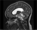Brainstem glioma (Radiopaedia 21819-21775 Sagittal T2 16).jpg
