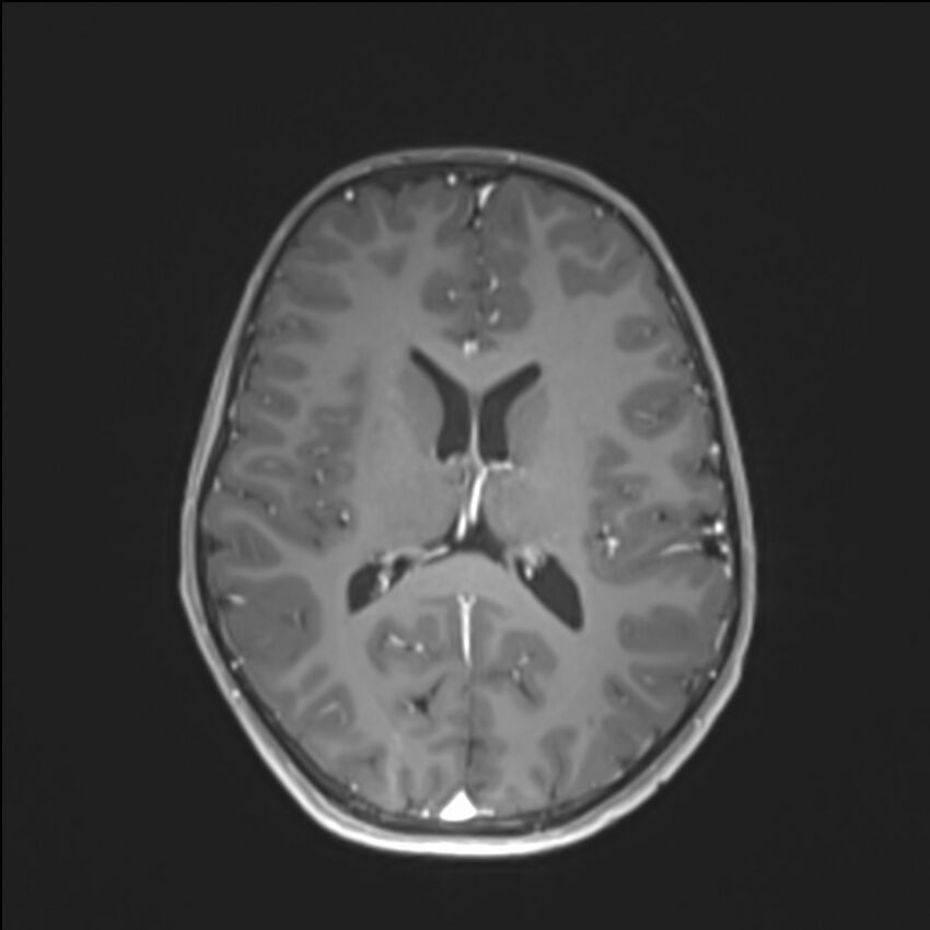 Brainstem glioma (Radiopaedia 70548-80674 Axial T1 C+ 94).jpg