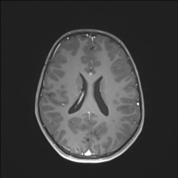 File:Brainstem glioma (Radiopaedia 70548-80674 Axial T1 C+ 99).jpg