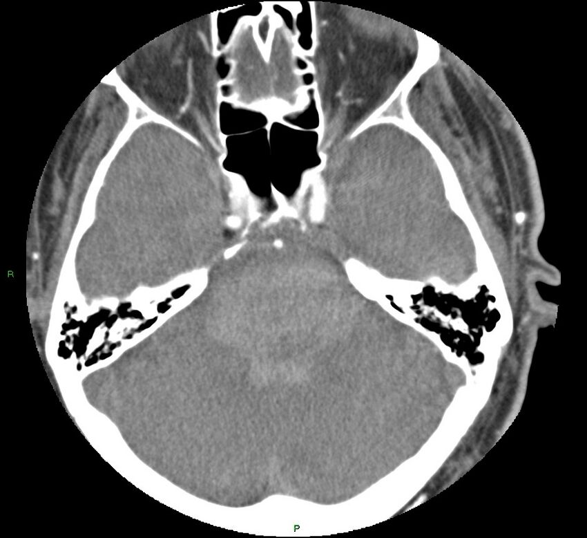 Brainstem hemorrhage (Radiopaedia 58794-66028 D 60).jpg