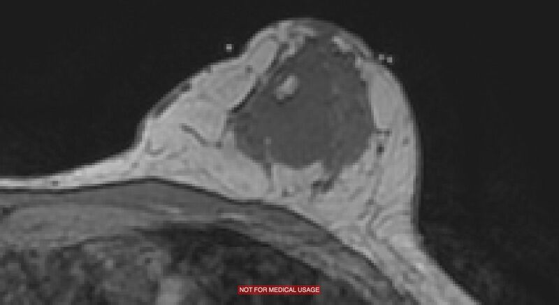 File:Breast lymphoma (MRI) (Radiopaedia 34999-36498 Axial T1 3).jpg