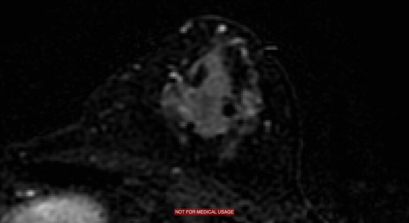 File:Breast lymphoma (MRI) (Radiopaedia 34999-36498 C 2).jpg
