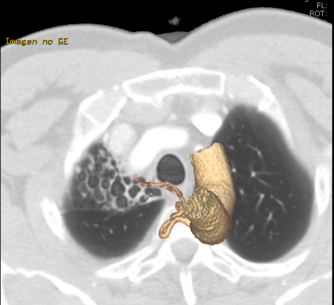 File:Bronchiectasis with bronchial arterial enlargement (Radiopaedia 25148-25417 Axial lung window 1).png