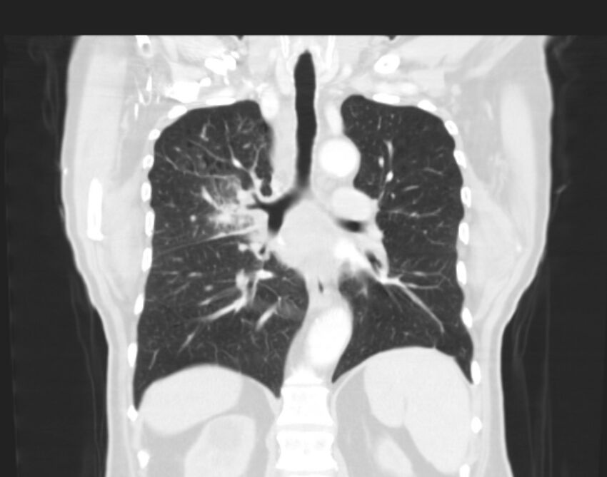 Bronchogenic carcinoma with lymphangitic spread (Radiopaedia 29002-29357 Coronal lung window 42).jpg