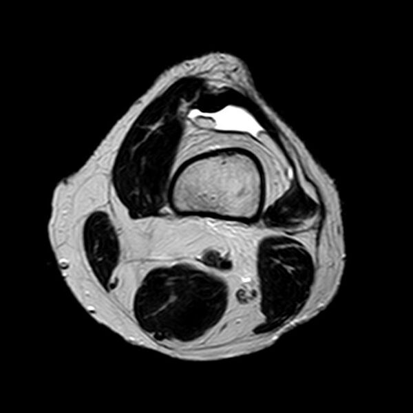 File:Bucket handle tear - medial meniscus (Radiopaedia 29250-29664 Axial T2 19).jpg