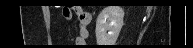File:Buried bumper syndrome - gastrostomy tube (Radiopaedia 63843-72575 Sagittal Inject 28).jpg