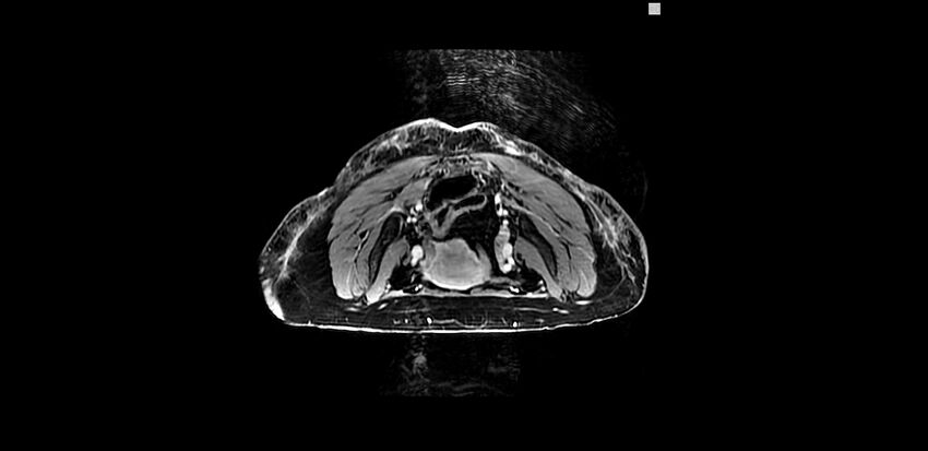 Buttock filler complications (Radiopaedia 63497-72115 Axial T1 C+ 5).jpg