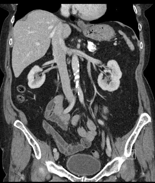 File:Calcified adrenal glands and Spigelian hernia (Radiopaedia 49741-54988 B 55).jpg
