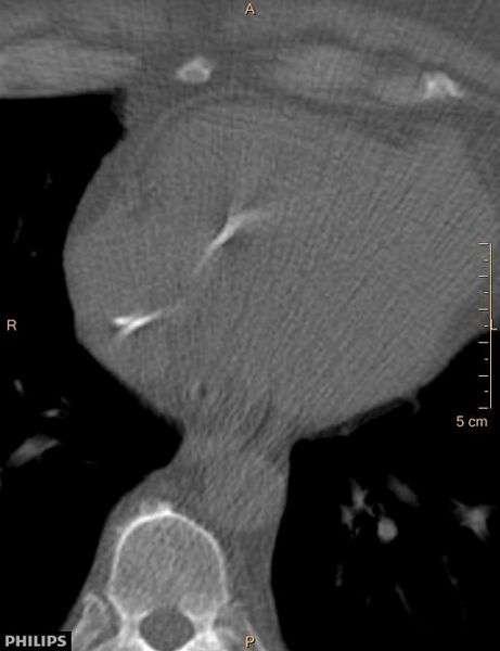File:Calcified cardiac fibroma (Radiopaedia 39267-41519 Axial bone window 15).jpg