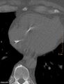 Calcified cardiac fibroma (Radiopaedia 39267-41519 Axial bone window 15).jpg