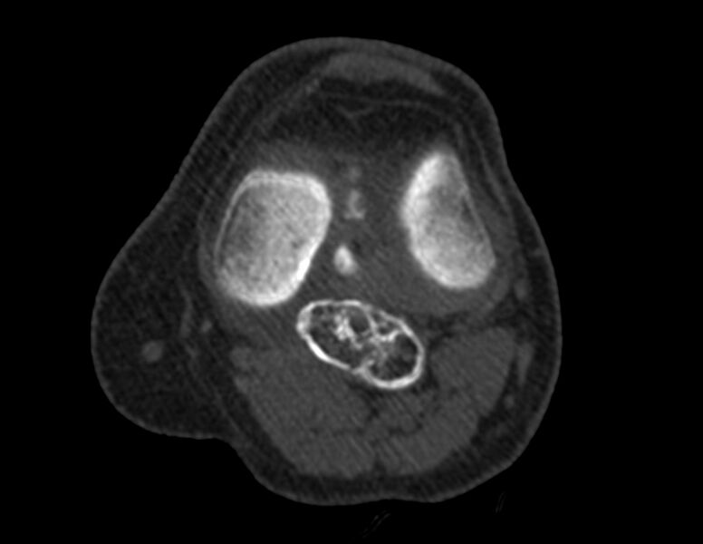 File:Calcified hematoma - popliteal fossa (Radiopaedia 63938-72763 Axial bone window 19).jpg