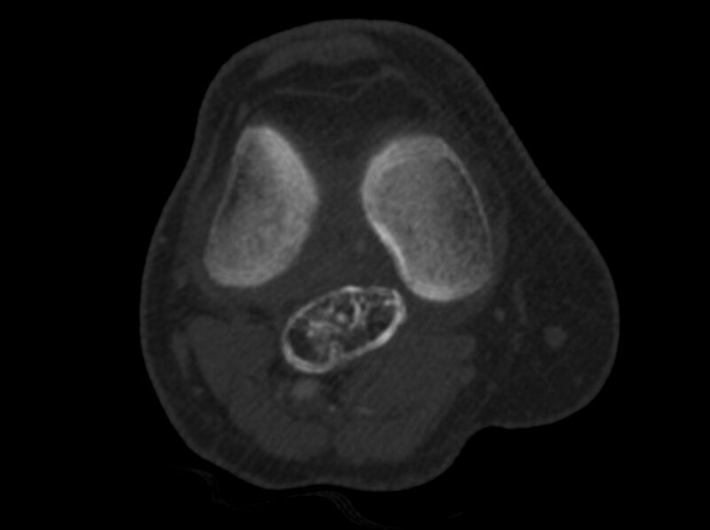 File:Calcified hematoma - popliteal fossa (Radiopaedia 63938-72763 C 16).jpg