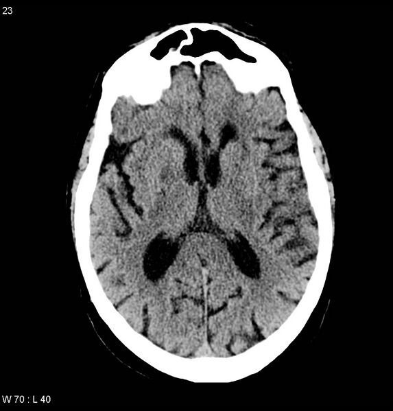 File:Calcified left middle cerebral artery embolism (Radiopaedia 5570-22120 Axial non-contrast 6).jpg