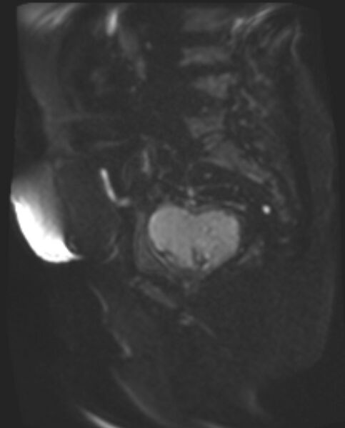 File:Cancer cervix - stage IIb (Radiopaedia 75411-86615 Sagittal DWI 62).jpg