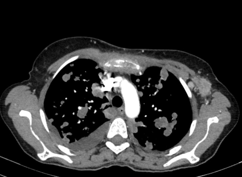 File:Cannonball metastases from breast cancer (Radiopaedia 91024-108569 A 36).jpg